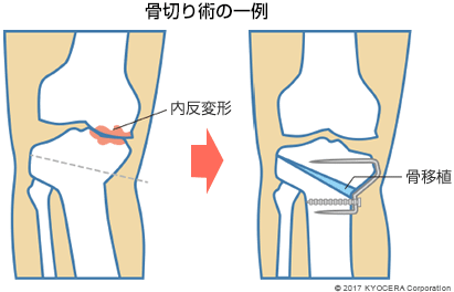 骨切り術の一例