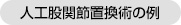 人工股関節置換術の例