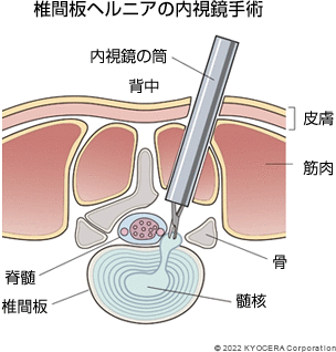 椎間板ヘルニアの内視鏡手術の図