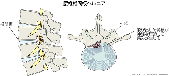 腰椎椎間板ヘルニアの図