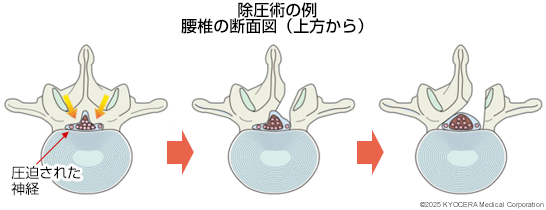 除圧術の例の図
