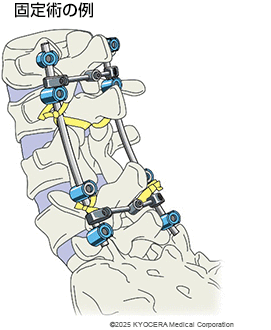 固定術の例の図