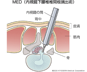 MED（内視鏡下腰椎椎間板摘出術）の図
