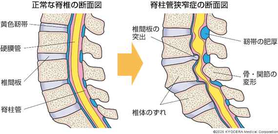 腰部脊柱管狭窄症の図