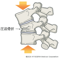 圧迫骨折の図