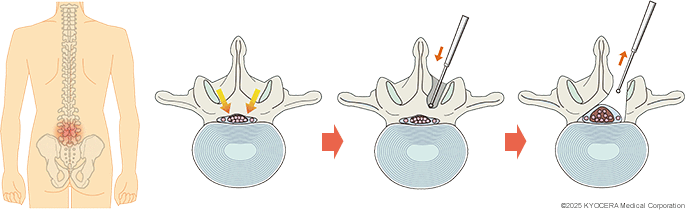 除圧術の例の図