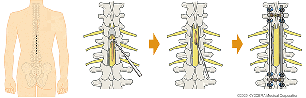 固定術の例の図