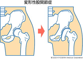 変形性股関節症の図
