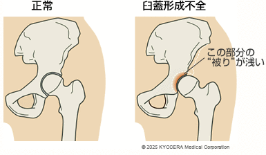 臼蓋形成不全の図