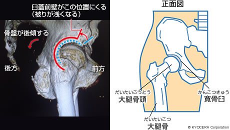 脱臼イメージと正面図