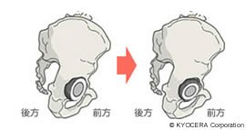 前開きの角度を小さくし、外開き角度を抑え気味に設置することで、前方に脱臼するリスクを減らす