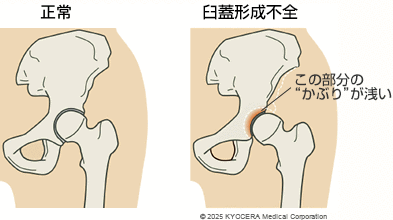 臼蓋形成不全の図