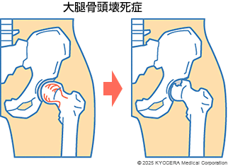 大腿骨頭壊死症の図