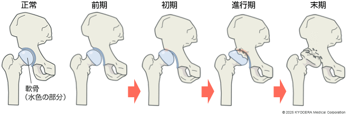 変形性股関節症の図