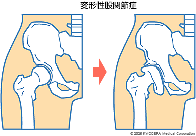 変形性股関節症の図