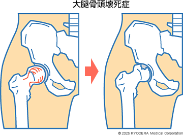 大腿骨頭壊死症の図