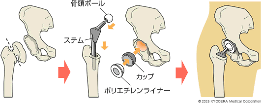 人工股関節置換術の例の図