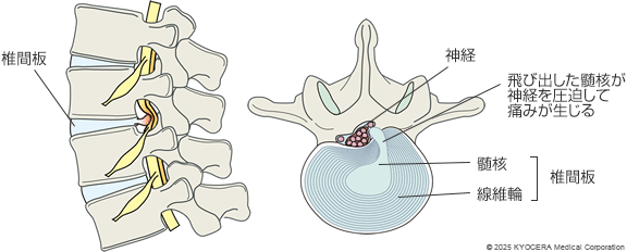 腰椎椎間板ヘルニアの図