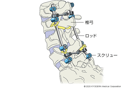 固定術の例の図