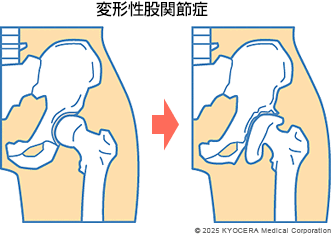 変形性股関節症の図