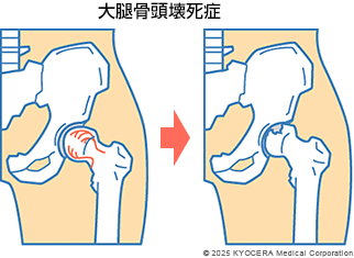 大腿骨頭壊死症の図