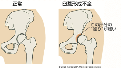 臼蓋形成不全の図