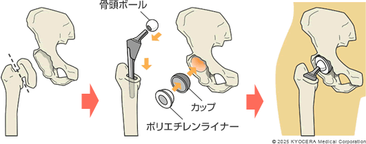 人工股関節全置換術の図