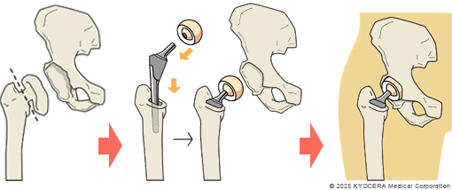 人工骨頭置換術の図