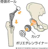 人工股関節の構造の図