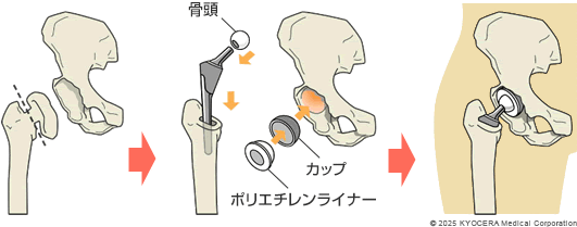 人工股関節置換術の図