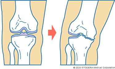 変形性膝関節症の図