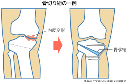 骨切り術の一例の図