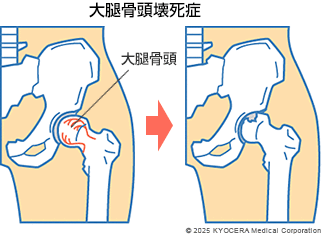 大腿骨頭壊死症の図