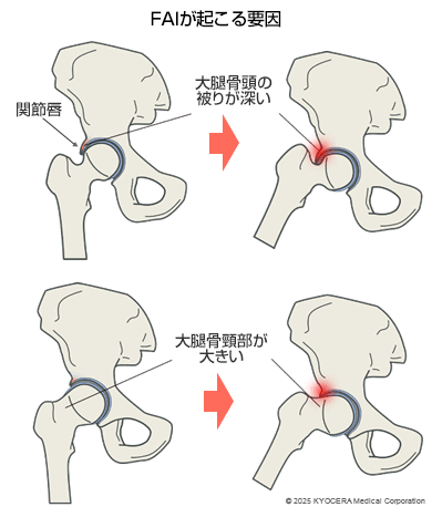 FAIが起こる要因