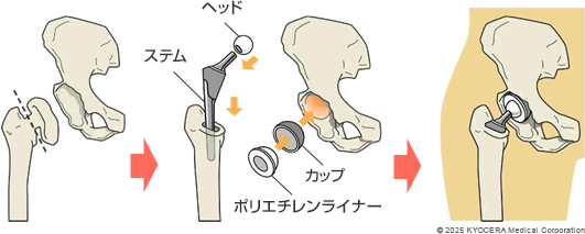 人工股関節置換術の例の図