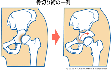 骨切り術の一例の図