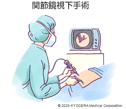 関節鏡視下手術の図