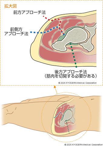 前方アプローチ法・前側方アプローチ法・後方アプローチ法の図