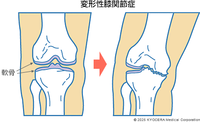 変形性膝関節症の図