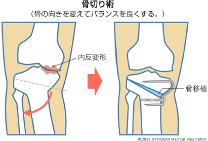 骨切り術の図