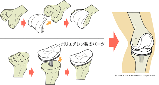 人工膝関節全置換術(TKA)の図