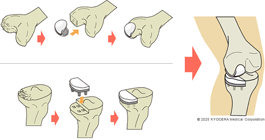 人工膝関節単顆置換術(UKA)の図
