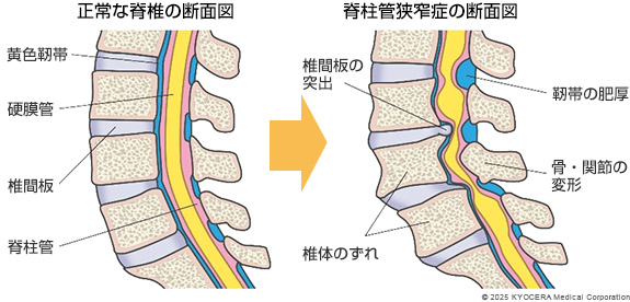 腰部脊柱管狭窄症の図