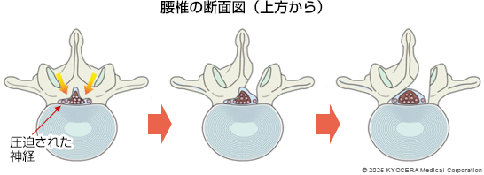 除圧術の例の図