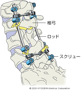 固定術の例の図