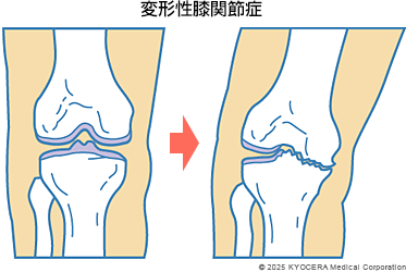 変形性膝関節症の図