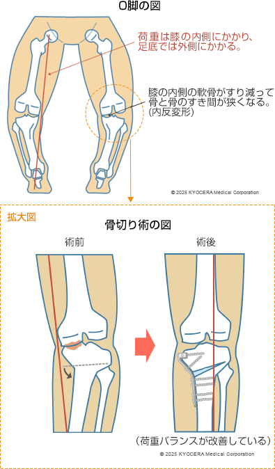 O脚の図と骨切り術の図