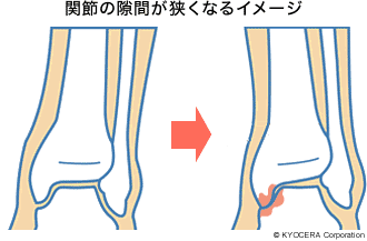 なる 足首 ポキポキ