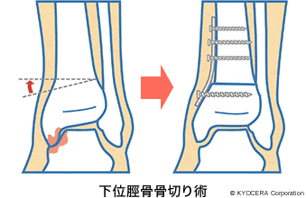 下位脛骨骨切り術