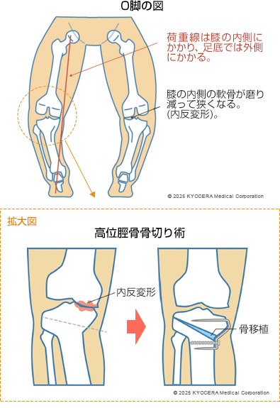 O脚の図と高位脛骨骨切り術
